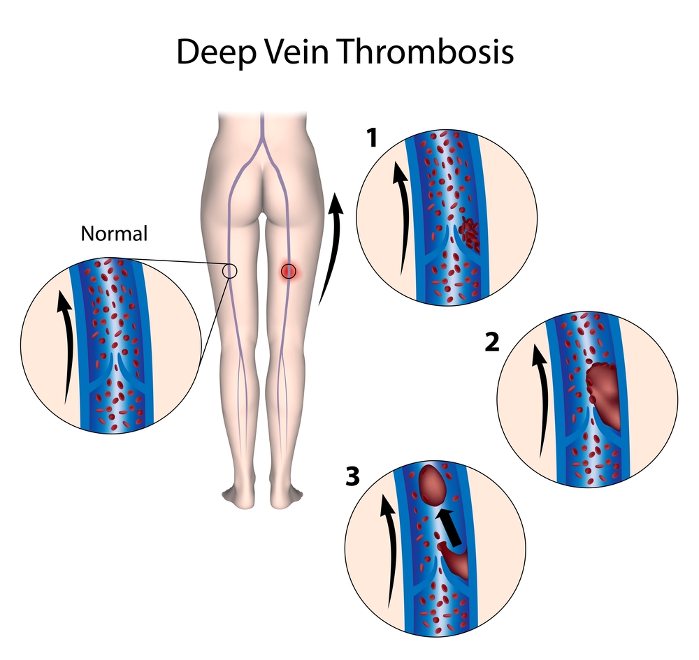deep vein trhombosis, blood clots.jpg